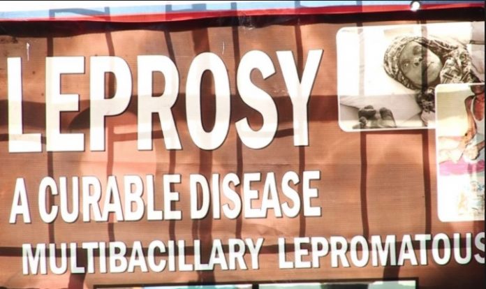 of leprosy